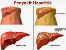 cara mengobati hepatitis b sampai sembuh permanen