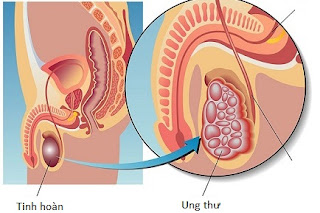 Đau tinh hoàn có phải triệu chứng bệnh ung thư tinh hoàn không ?