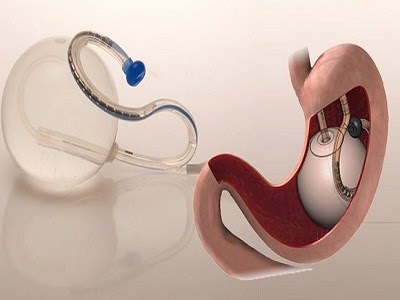 Intragastric Balloons Market - TechSci Research