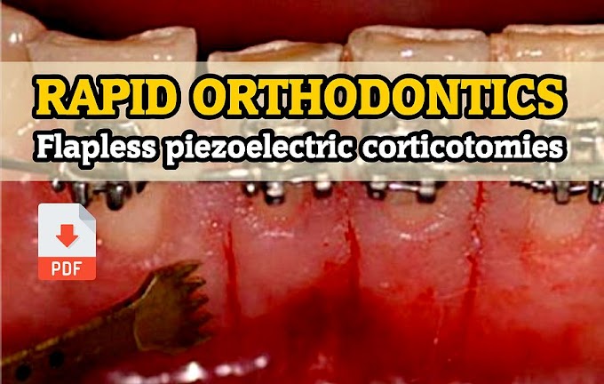 PDF: Rapid Orthodontics with Flapless Piezoelectric Corticotomies: First Clinical Experiences