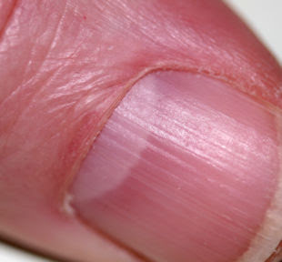Fingernail Ridges and Health