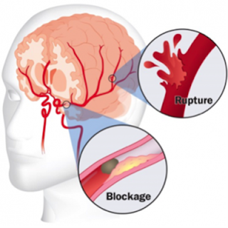 Cara Mengobati Stroke Awal, Obat Stroke Dari Tanaman, Cara Terapi Mengobati Penyakit Stroke, Jumlah Penderita Penyakit Stroke Di Indonesia, Cara Mengobati Penyakit Stroke Alami, Obat Untuk Stroke, Penyakit Stroke Akibat Apa, Tumbuhan Obat Stroke Ringan, Penyakit Stroke Doc, Penyakit Silent Stroke, Obat Sakit Stroke, Cara Menyembuhkan Stroke Dengan Herbal, Cara Untuk Mengobati Penyakit Stroke, Penyakit Stroke Sebelah, Obat Stroke Sembuh 