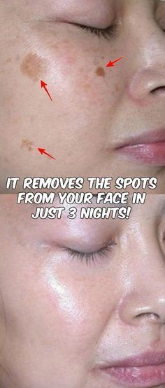 IT REMOVES THE SPOTS FROM YOUR FACE IN JUST 3 NIGHTS!