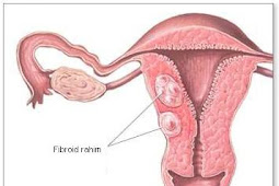 Waspadai Fibroid (Mioma) Pada Wanita