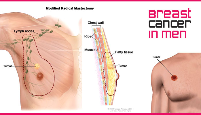 ছেলেদের স্তন ক্যানসারের ঝুঁকি ও চিকিৎসা,ব্রেস্ট ক্যান্সারবা স্তন ক্যান্সার,ব্রেস্ট ক্যান্সারের ঝুঁকি রয়েছে পুরুষদেরও