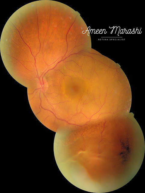 Fundus image of the Left Eye showing RD from exudative metastatic choroidal mass