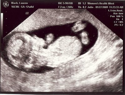 12 5 week ultrasound. 12 5 week ultrasound. You are weeks days pregnant; You are weeks days pregnant. chaoticbear. Apr 12, 10:39 AM