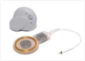 cochlear implant