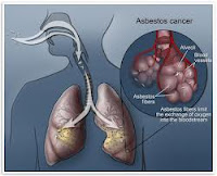 Mesothelioma and asbestos