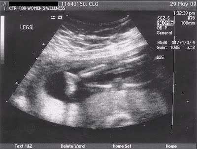 images of 5 week fetus. 5+week+fetus+ultrasound