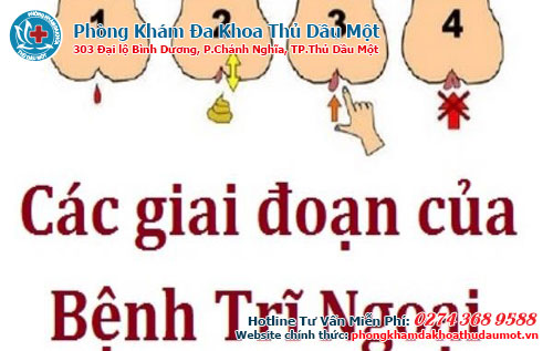 Biểu hiện bệnh trĩ giai đoạn cuối như thế nào