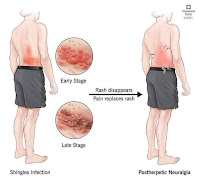 Shingles Infection.