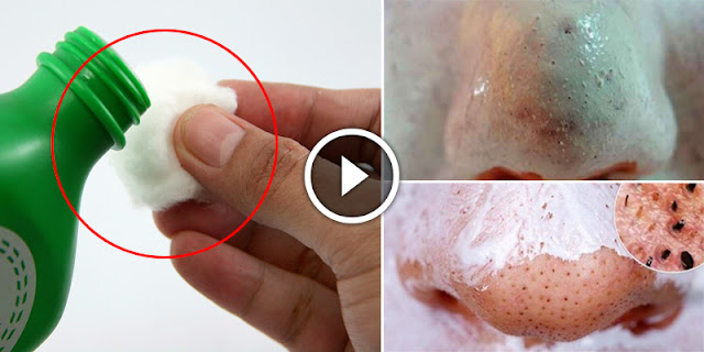 How To Get Rid Of Blackheads On Nose And Face!