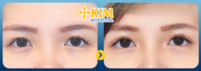 Bấm mí mắt được thực hiện với đường rạch mổ nhỏ, khéo léo, nhờ vậy không để lại sẹo.