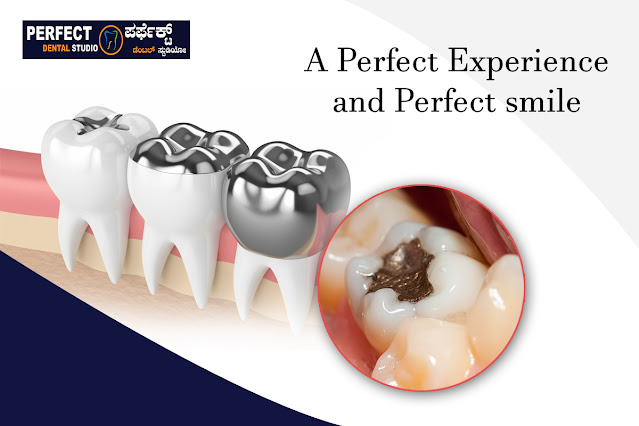 Teeth Fillings in BTM Layout