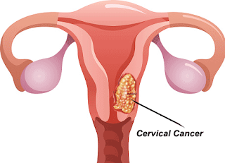 Cervical Cancer - Cancer Specialist Doctor In Delhi