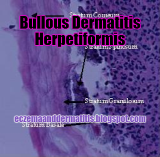 Bullous Dermatitis Herpetiformis