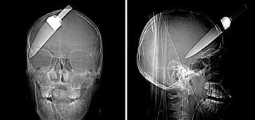 16 year old x ray image Hasil Foto X ray yang Ekstrim