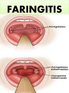 Penyakit Faringitis