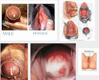 Nyeri Pada Penis Serta Keluar Cairan Putih  Seperti Nanah Penyakit Apa ?