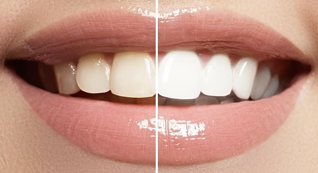 teeth whitening