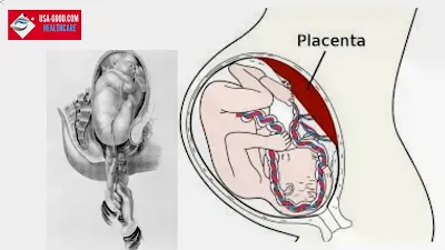 What is Placenta accreta?
