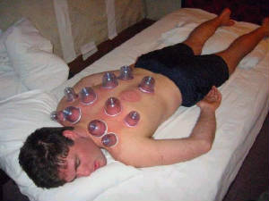 cupping