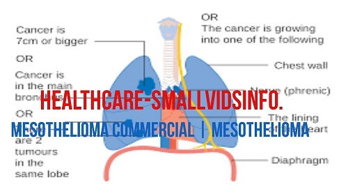 Mesothelioma Commercial Annoying1