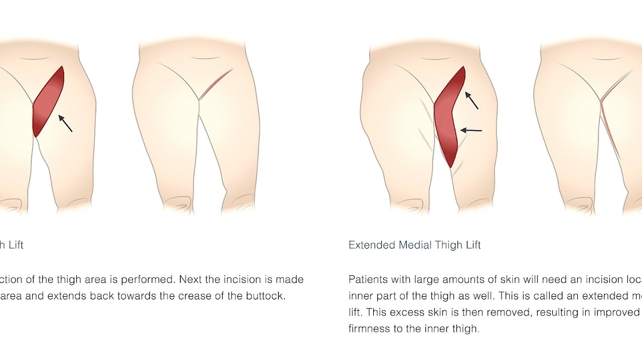 Inner Thigh Lift Scar