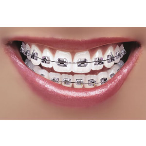 How to whiten teeth with Braces. | Weight Loss and Fitness