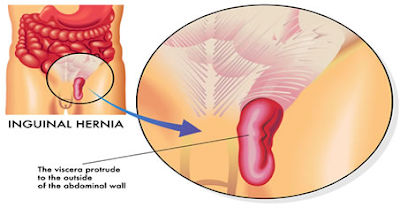 mengatasi hernia, mengobati hernia, cara mengobati hernia, cara mengatasi hernia