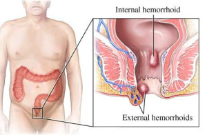 Obat Herbal Sakit Sembelit