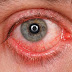 Chlamydial conjunctivitis vs. Gonococcal conjunctivitis Symptoms, Causes and Treatment