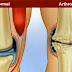 Informe sobre Artrosis en las rodillas