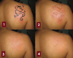 tattoo removal - before and after