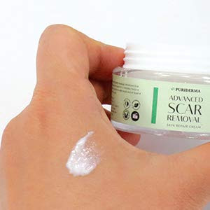 scar removal cream