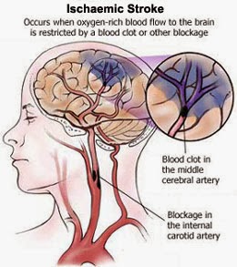 Obat Penyakit Stroke Herbal