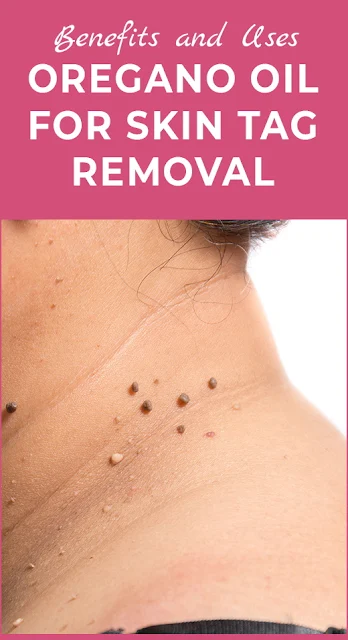 Benefits and Uses and Precautions Oregano oil for Skin Tags