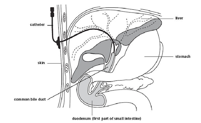 Gambaran prosedur tindakan percutaneous transhepatic cholangiography (PTC) / Kolangiografi transhepatic perkutan, duktus koledokus, saluran empedu, kateter, kulit, batu empedu, kolelitiasis, pemeriksaan penunjang, duodenum, usus halus, abdomen kuadran kanan atas