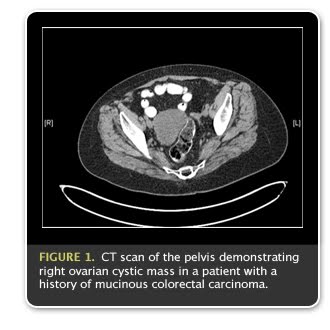 Nhsukconditionscancer Of The Lungpagescausesaspx