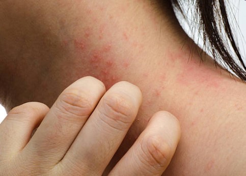 8 Best Essential Oils for Heat Rash: Quick Natural Remedies #Health Remedies