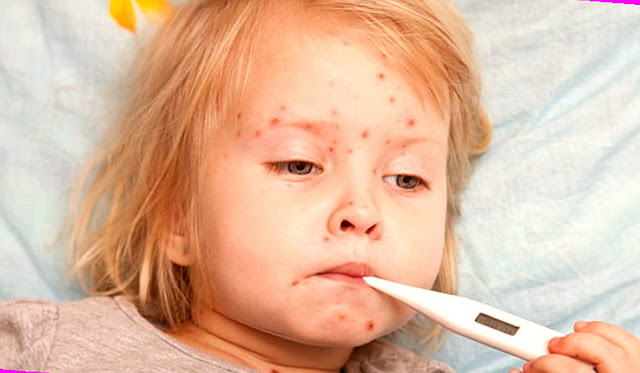 Measles Symptoms