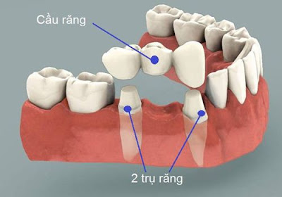 Địa chỉ trồng răng giả cố định