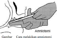 Amniotomi