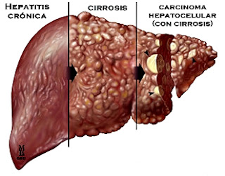 Hepatitis C síntomas tratamientos riesgos salud