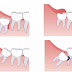  Không nhổ bỏ răng khôn mọc lệch thì sao?