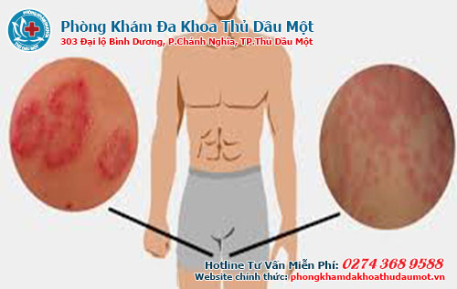 Ở đâu bán thuốc Điều trị ngứa bộ phận kín bạn nam Ở đâu Bình Dương, Đồng Nai