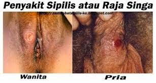 Sipilis Pada Wanita Dan Pria