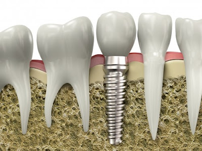 Implant răng có đau không – thực tế cấy răng có gây đau nhức