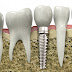 Implant răng có đau không ?